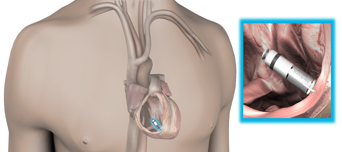 図）Micra経カテーテルペーシングシステム