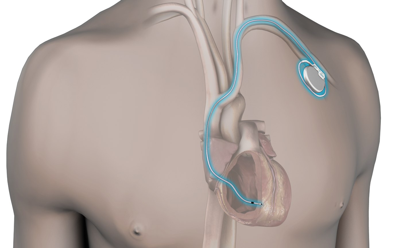 図）従来のペースメーカ
