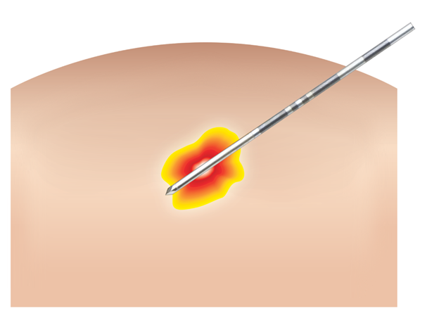 焼灼中イメージ