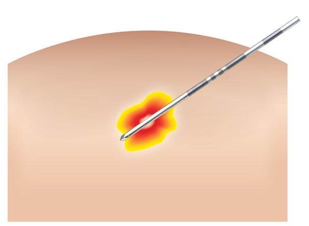 メドトロニック ラジオ波焼灼療法で用いる「Cool-tip RFAシステム Eシリーズ」が早期乳がんへの使用で新たに保険適用を取得 | 日本 ...