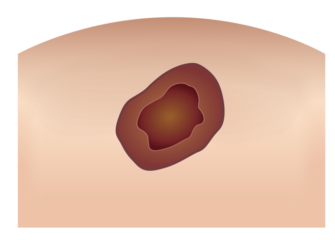 焼灼後イメージ