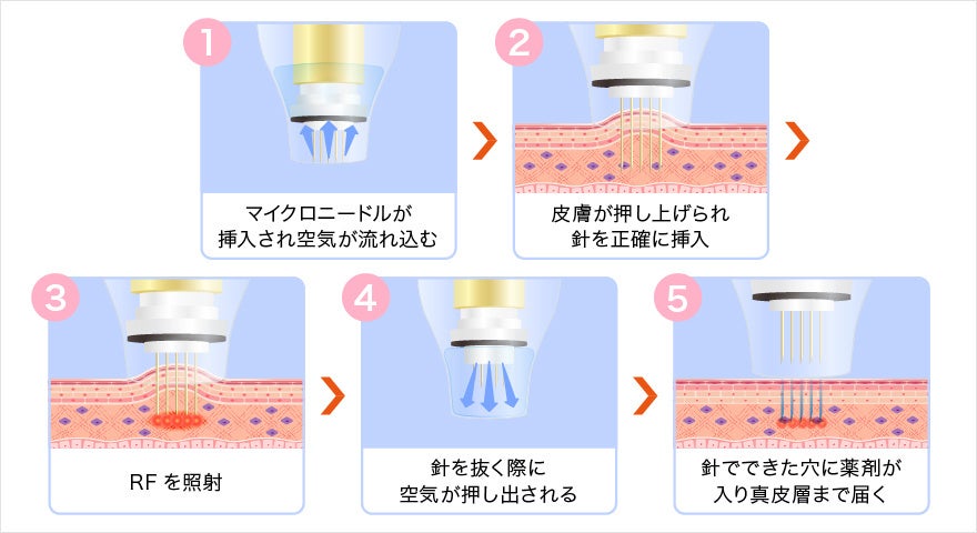 ドラッグデリバリーシステムの施術イメージ