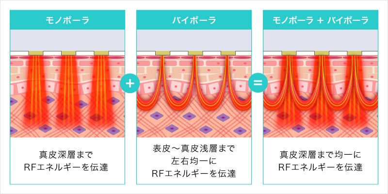 ダイヤモンドチップの施術イメージ