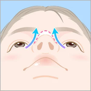 鼻尖形成 変化のイメージ