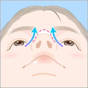 鼻尖形成 変化のイメージ