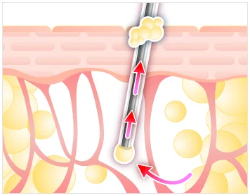 注射器による脂肪吸引のイメージ