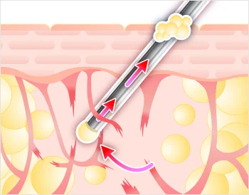 従来のカニューレによる吸引イメージ