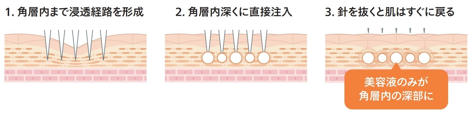 CONCリンクル インジェクション