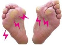 足の裏の厚いタコ