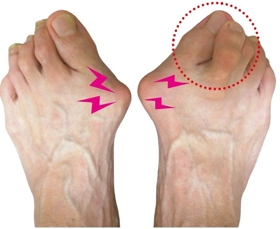 指の付け根の変形