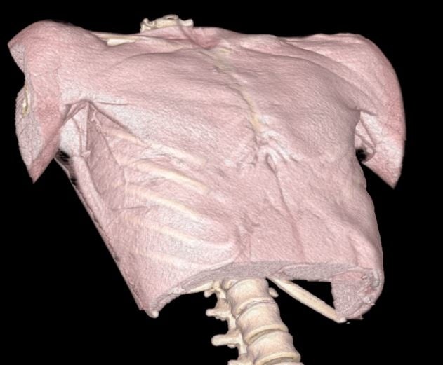 自動作成した乳房切除術の術後説明画像