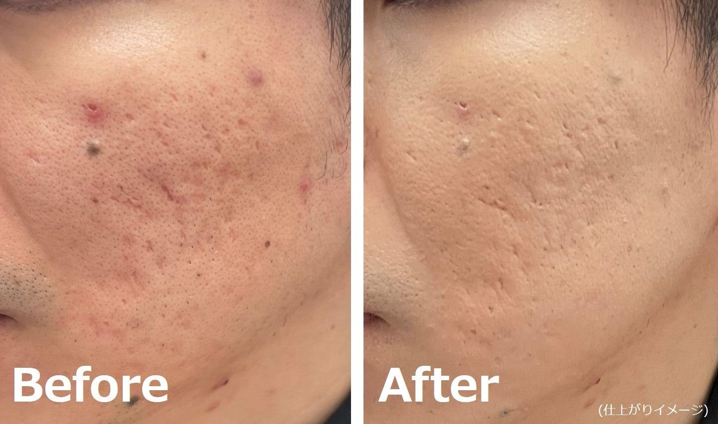 ニキビ跡に悩む肌にBBクリーム1品を使用したときの仕上がり比較