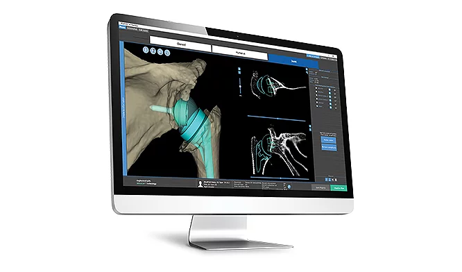 Blueprint術前計画ソフトウェア