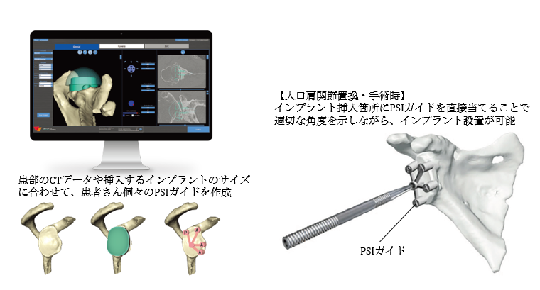 日本ストライカー、肩関節分野でもデジタル活用を加速 | 日本
