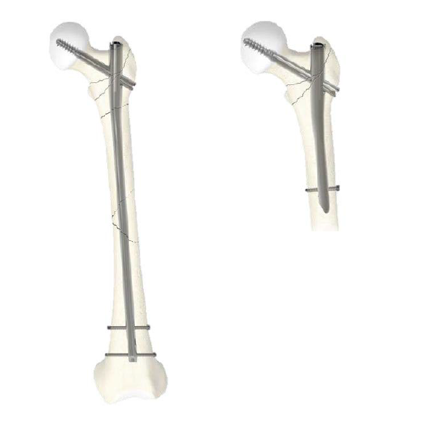 ガンマ4　使用イメージ図（左：ロングネイル、右：ショートネイル）