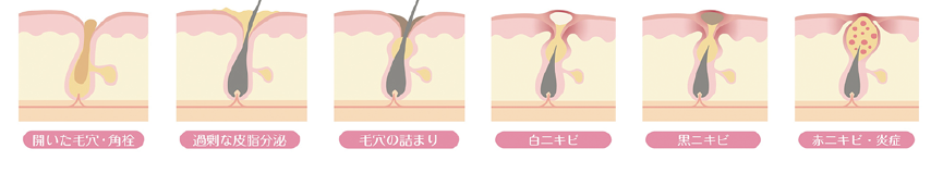 毛穴にまつわる悩み
