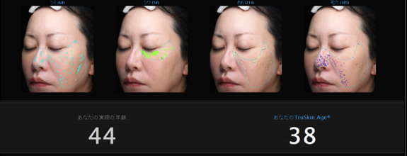解析結果イメージ（左が実年齢、右が肌年齢）※シミ・しわ・毛穴の個数なども同時解析