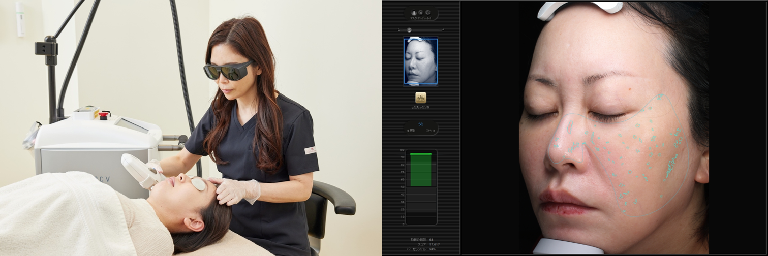 左：レーザー治療が人気、右：シミの個数や肌年齢を 3分でマシン測定も