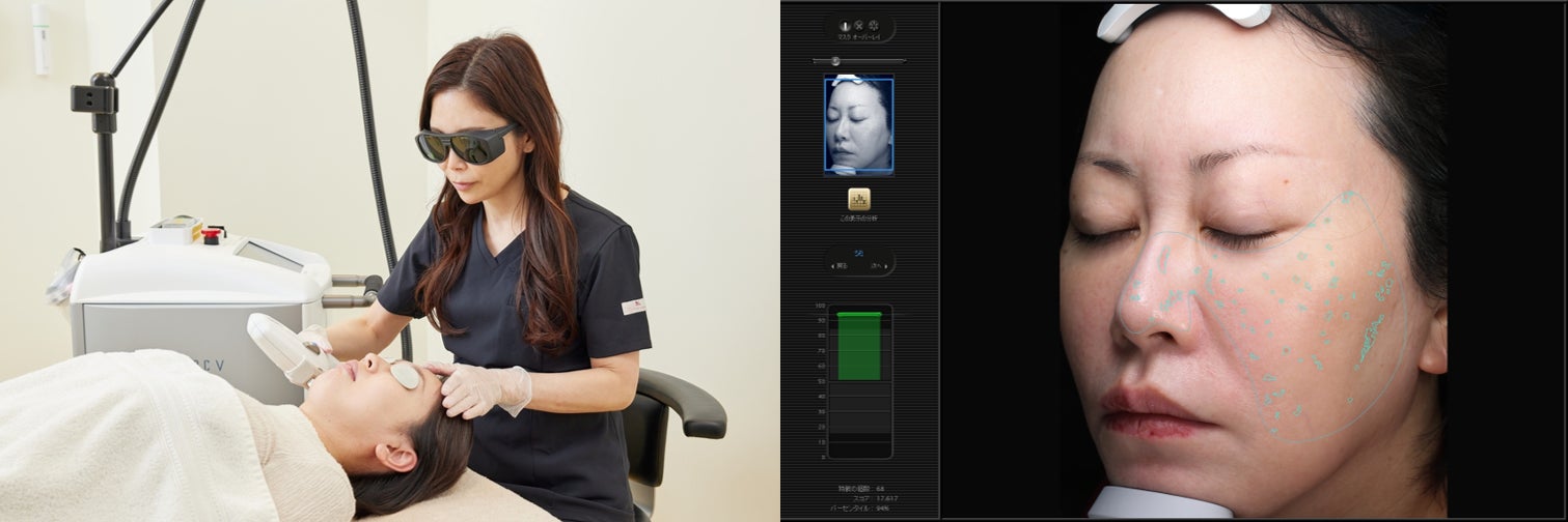左:レーザー治療が人気、右:シミの個数や肌年齢を 3分でマシン測定も