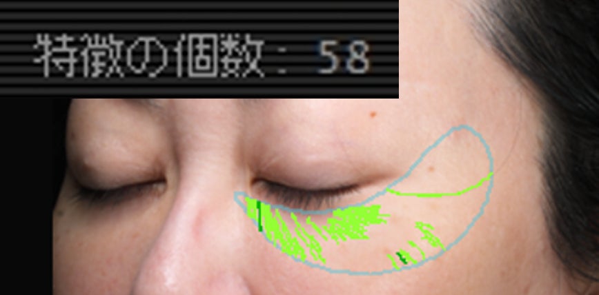 <シワの測定> 目もとに58本のシワを確認 (聖心美容クリニックにて測定)