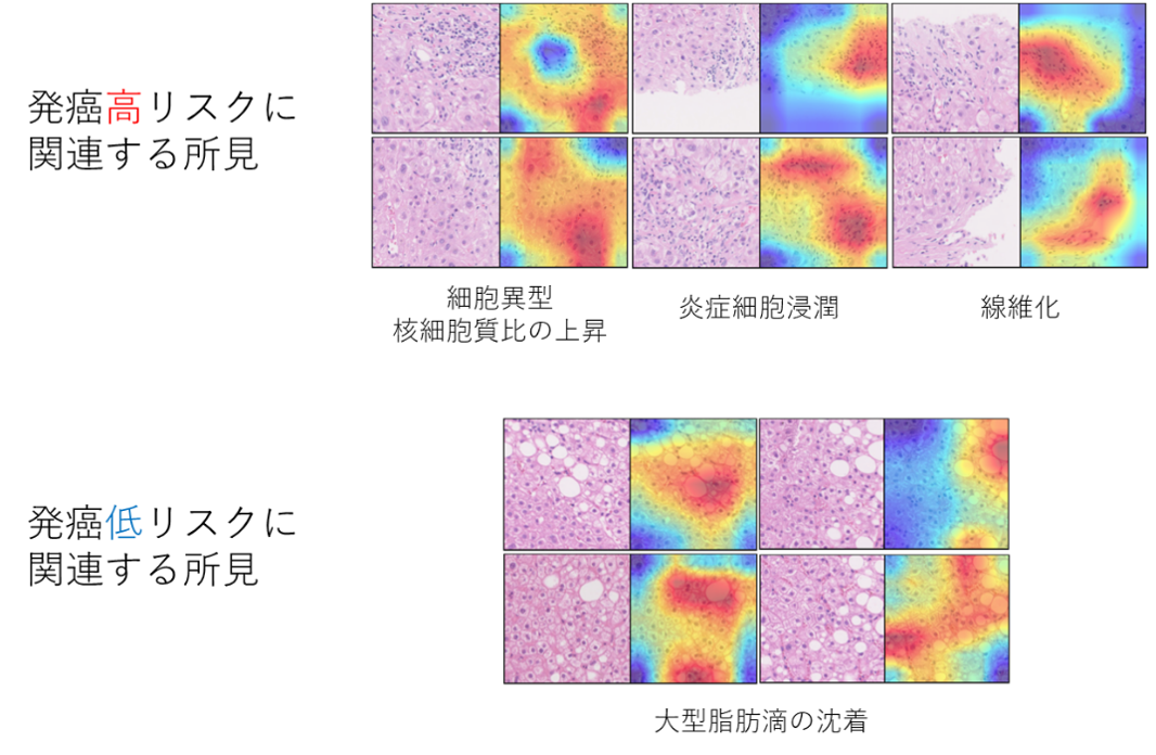 図2：AIが注目した肝がん発症に関連する病理学的所見