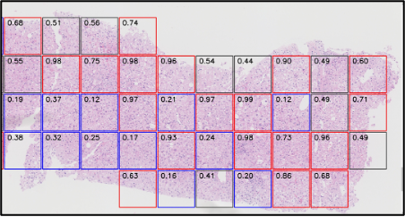 AIが脂肪肝病理画像から肝発がんリスクを推定する （赤枠は発がん確率が高く、青枠は発がん確率が低い、平均して全体の確率を計算する）