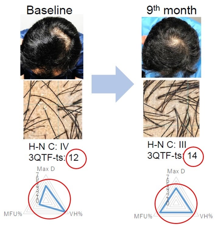 上島 朋子医師　Journal of Cosmetic Dermatology（JCD）論文掲載より