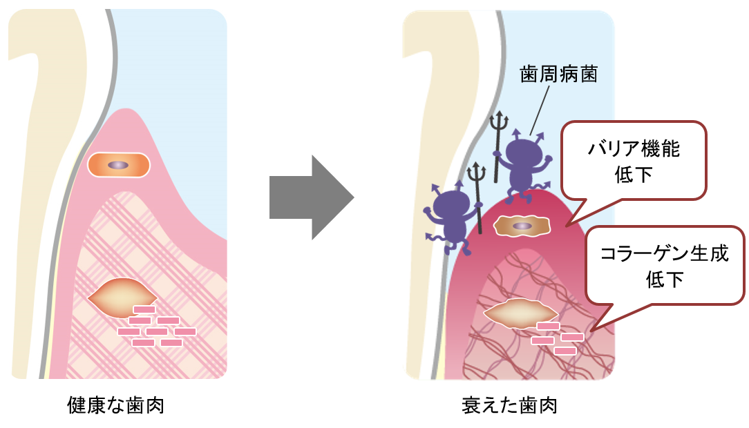 図2　歯ぐきが衰えるメカニズム