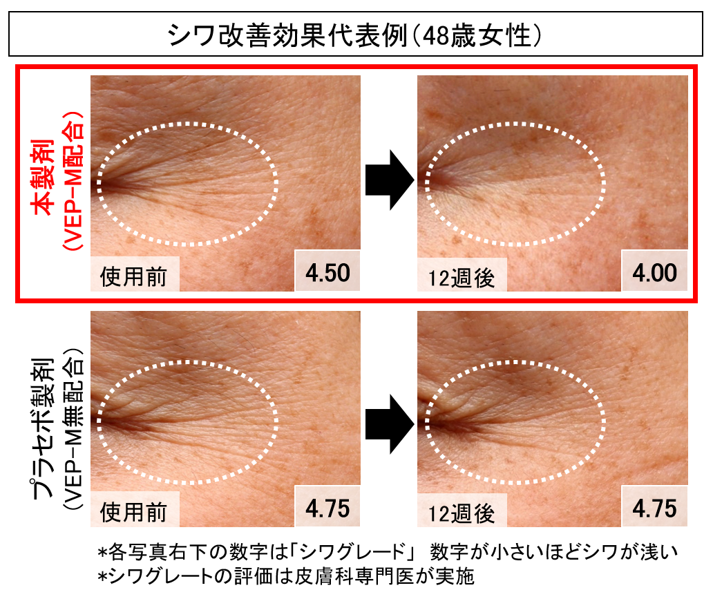 VEP-Mによるシワ改善効果代表例