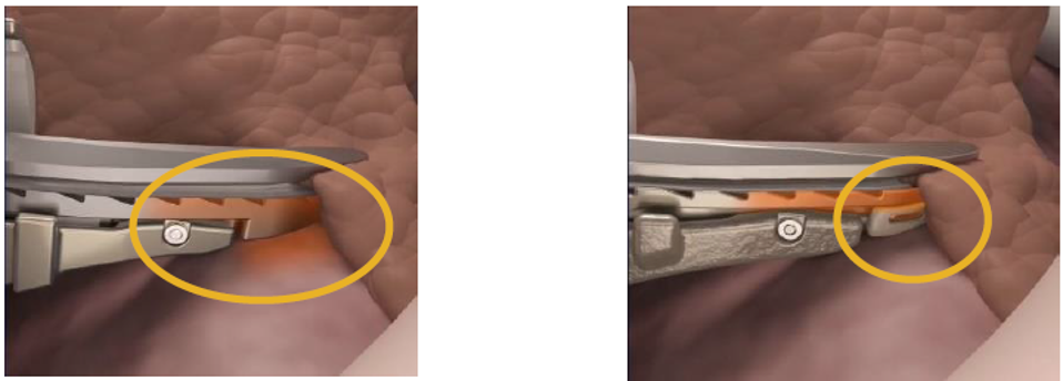 ▲サーマルシールド（イメージ） （左）従来機種、（右）THUNDERBEAT Open Fine Jaw Type X