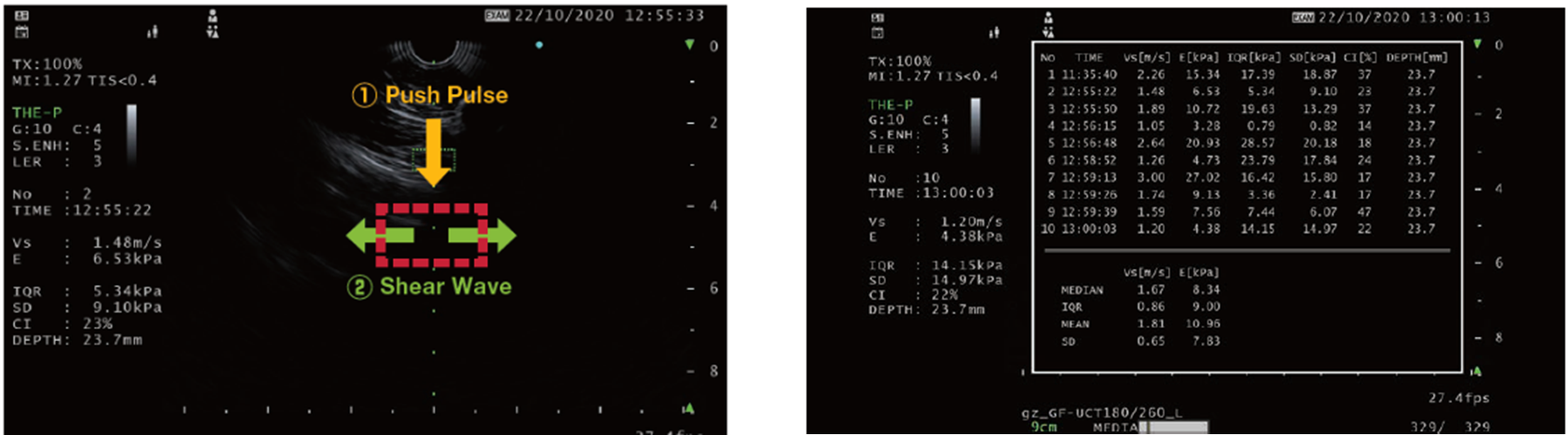 ▲シアウェーブ計測画像（イメージ）