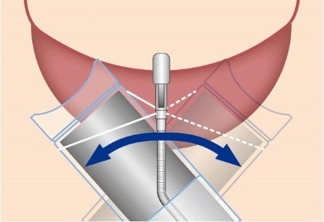 ▲切除時の内視鏡操作（イメージ）