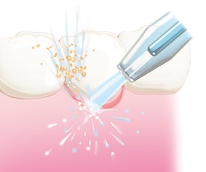 歯周ポケット汚れにも