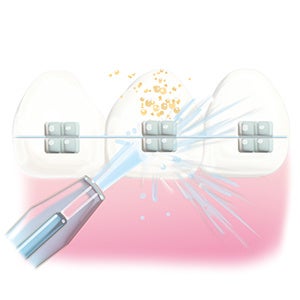 矯正器具がついた歯にも使えます