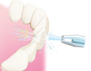 歯間の汚れを水流で除去