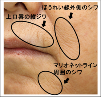 図1．口まわりのシワ
