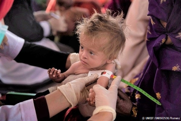 カンダハールで、移動式保健・栄養チームが子どもの栄養状態を調べている。上腕計測メジャーで「赤色」が示され、重度の栄養不良と診断された子ども。 (2021年11月17日撮影) © UNICEF_UN0562536_Romenzi