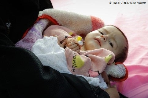 首都サヌアのパレスチナ病院で、重度の脱水症状と栄養不良で腎不全に陥り、入院して治療を受ける生後10カ月のファーティマちゃん。(イエメン、2021年10月撮影) © UNICEF_UN0536065_Haleem 