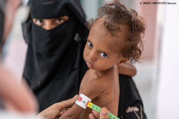 重度の栄養不良、下痢、感染症でアデン州の病院にて治療を受けるゴッソンちゃん。入院時にわずか5kgだった体重は7kgまで増えた。(イエメン、2021年6月撮影) © UNICEF_UN0492395_Hayyan