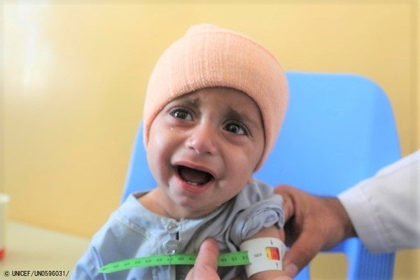 カンダハールの総合保健センターで、上腕計測メジャーを使った検査で「赤」が示され、重度の急性栄養不良と診断された1歳のシャリフラちゃん。(アフガニスタン、2022年1月撮影) © UNICEF_UN0596031_