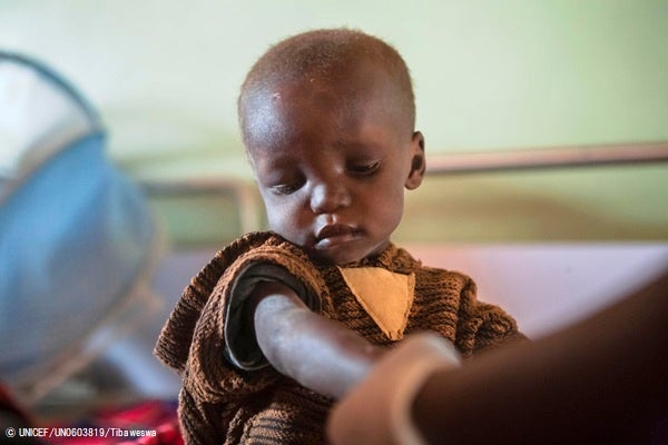 すぐに食べられる栄養治療食(RUTF)と栄養価の高い治療用ミルク(F-75)のおかげで、重度な栄養不良から症状が回復しつつある赤ちゃん。(ウガンダ、2022年2月撮影) © UNICEF_UN0603819_Tibaweswa