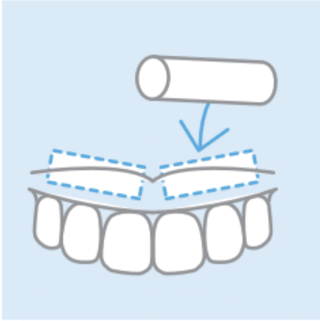 デンタルコットン。歯茎と唇の間に挟み唇を開いて塗りやすくなる