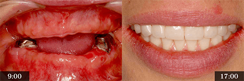 たった1日で噛める歯を提供します