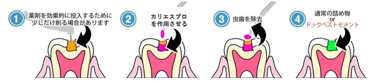 健康な歯を削るのを最小限に抑えられます。