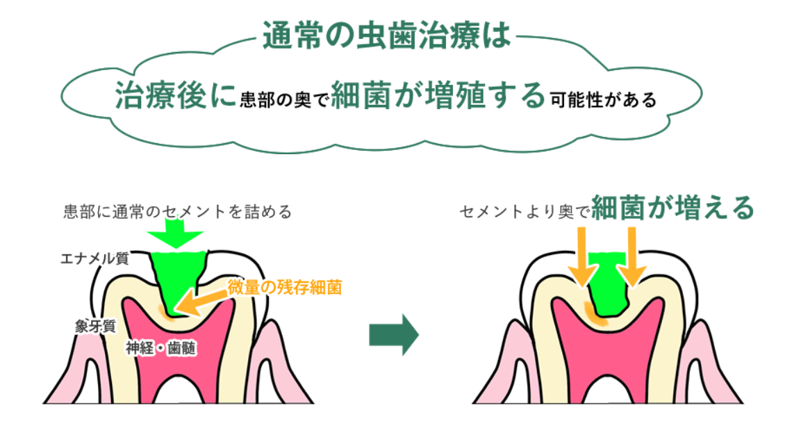 通常の虫歯治療は、治療後に患部の奥で細菌が増殖する可能性があります