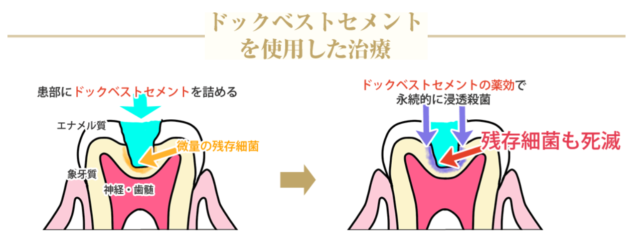 ドックベストセメントの薬効で永続的に浸透殺菌、残存細菌も死滅します