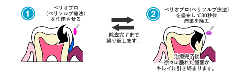 ぺリオプロなら出血や2次感染のリスクをなるべく抑えられます