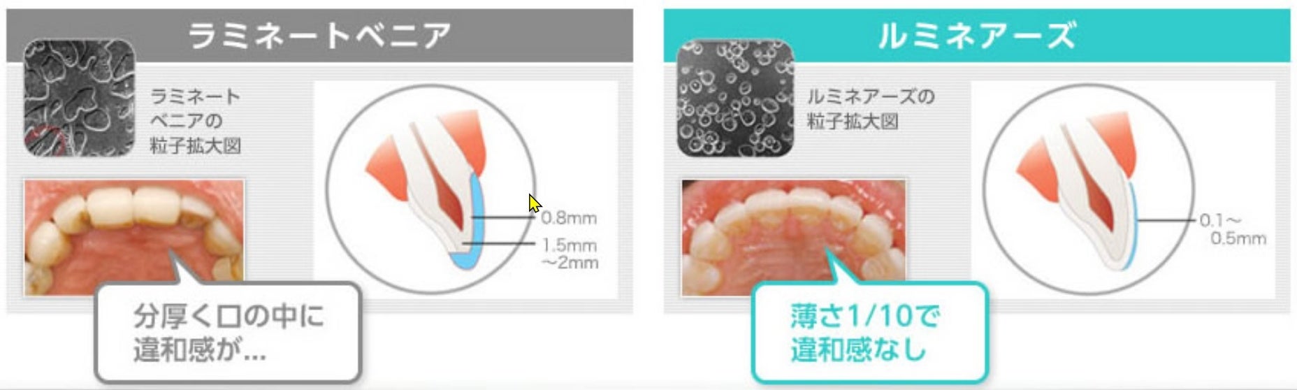 ラミネートベニアとルミネアーズの厚みの比較