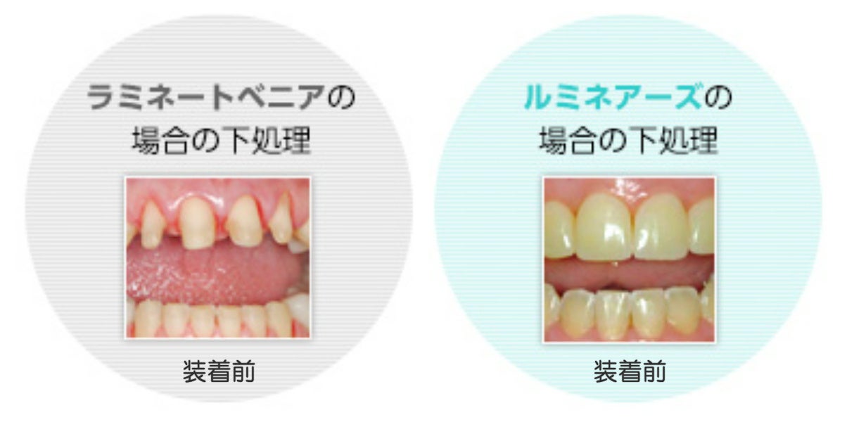 ラミネートベニアとルミネアーズの下処理の比較