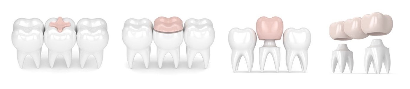 インレー・アンレー・クラウン・ブリッジ